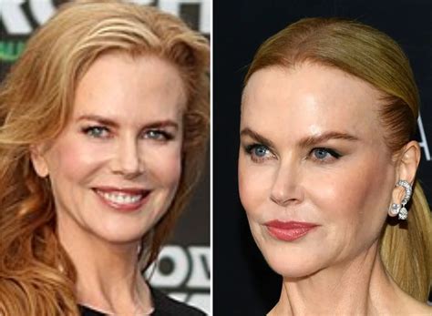 Nicole Kidman Plastic Surgery Face Did Nicole Kidman Have Plastic
