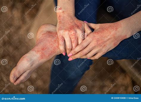 Dermatitis Eczema En Manos Y Pies. Manchas Rojas En La Piel. Piel Seca Foto de archivo - Imagen ...