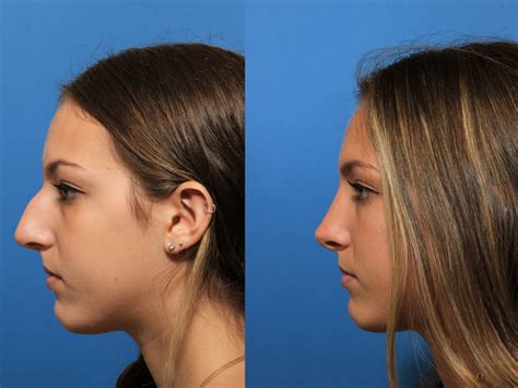 Nose Job With Laser at Brittany Elrod blog