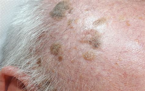 Seborrheic Keratosis (senile warts) removal