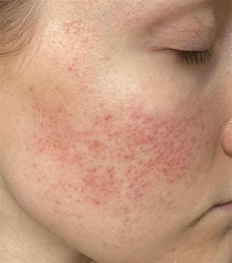 What is this?? This patch of dark red spots used to be much smaller and only on one cheek. Now ...