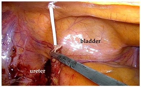 Laparoscopic and Robot-Assisted Laparoscopic Management of Iatrogenic Ureteral Strictures ...