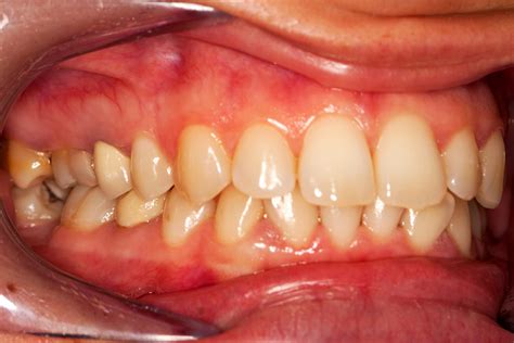 Early Gingivitis Symptoms Gum Disease 101: Causes, Symptoms, And