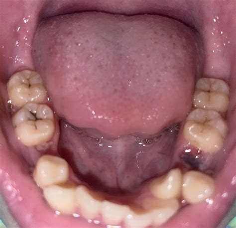 What are the black lines on my molars? : r/DentalHygiene