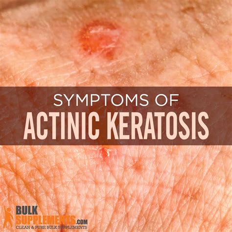 Actinic Keratosis Description Actinic Keratosis: Treating A Potential