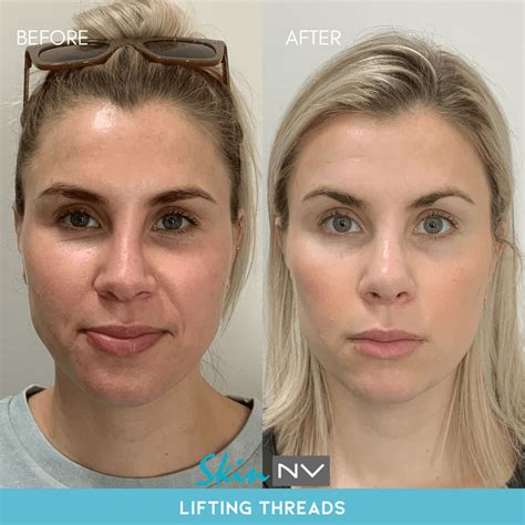 Face Lift Using Threads