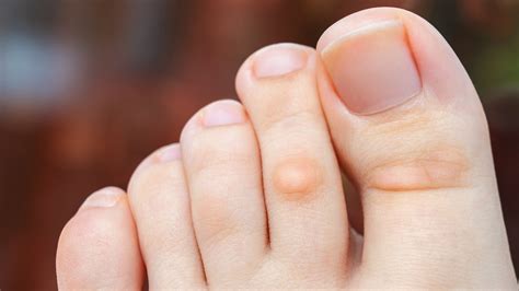 Corns vs. Calluses: Symptoms, Causes, and Images - GoodRx