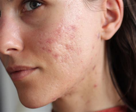 My Experience With Microneedling for Acne Scars - Frivolous Girl