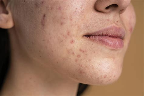 Are Hives Contagious: Types, Symptoms and Treatments | Credihealth
