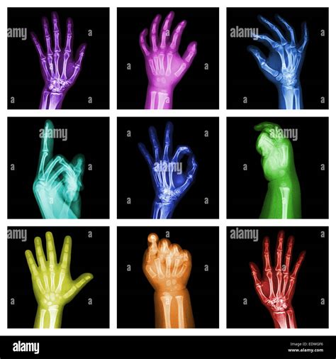 Collection of colorful x-ray hands Stock Photo - Alamy