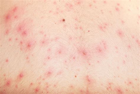 Why Chickenpox Called Chickenpox