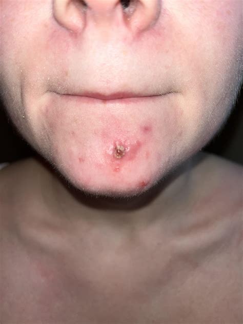 Gram Negative Folliculitis : r/Folliculitis