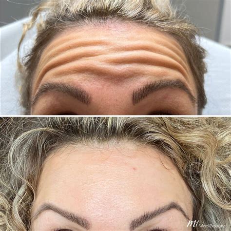 Forehead Lines Anti-Wrinkle Treatment - M1 Med Beauty Australia
