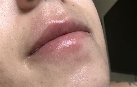 Itchy/bumpy upper/lower lips/surrounding mouth skin : r/medical_advice