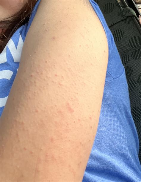 I have Keratosis pilaris and have been popping the bumps for years. The constant popping has ...