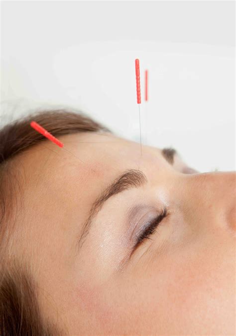 Acupuncture — Ground Floor Health Integrative Naturopathic Medicine