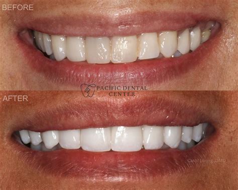 Smile Gallery - Pacific Dental Center