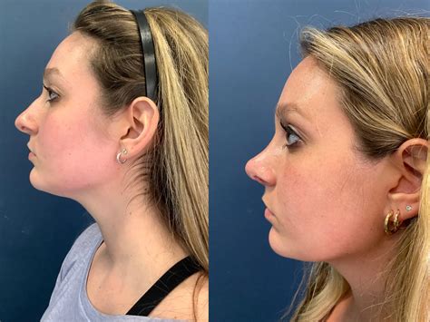 Nose Job Recovery Bruising