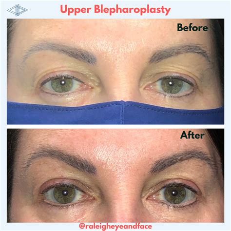 Raleigh Eye and Face Plastic Surgery - Raleigh Eye and Face Plastic Surgery - Serving Raleigh ...