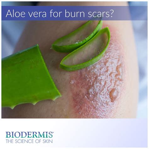 Aloe Vera Burn