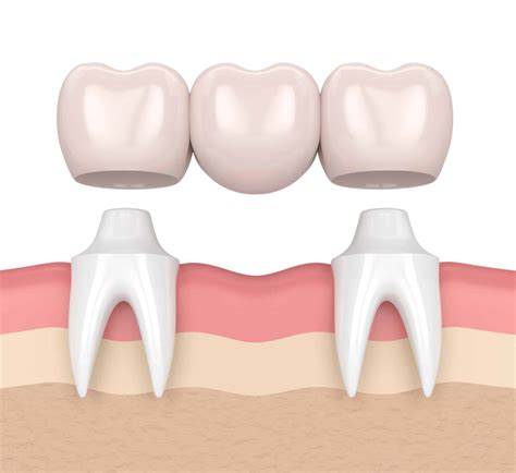Dental Bridges: An Introduction to Restoring Your Smile
