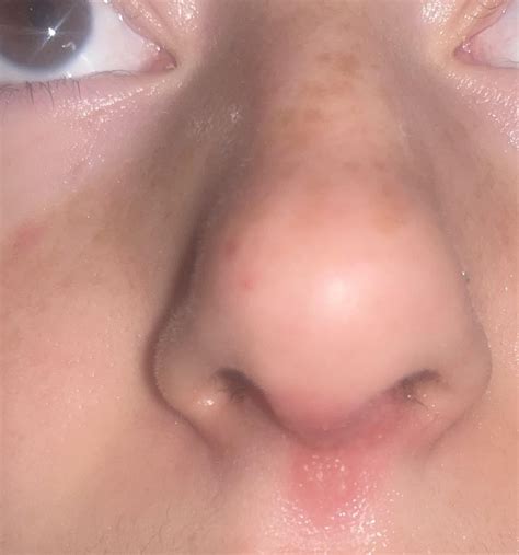 Help what is this rash/bumps under my nose after being sick for 4 days : r/SkincareAddicts