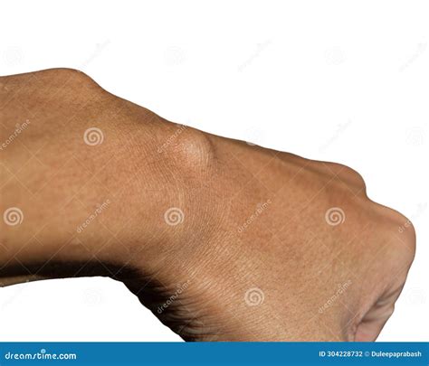 Wrist Ganglion Cyst Disease , Ganglion Cyst , a Fluid-filled Lump Under the Skin , Pain Hand ...