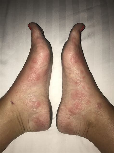 Foot Rash On Side Of Foot Online | emergencydentistry.com
