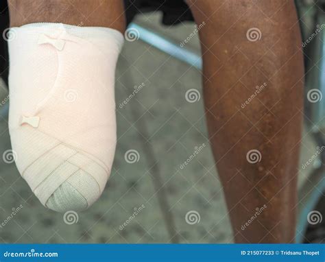 Elastic Bandaged Below Knee Amputation Stock Image - Image of amputation, adult: 215077233