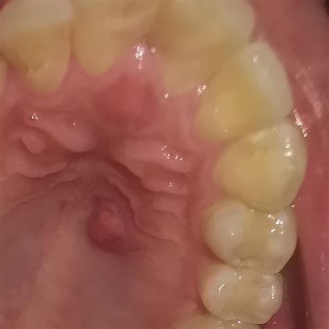 Bump On Roof Of Mouth | Renew Physical Therapy
