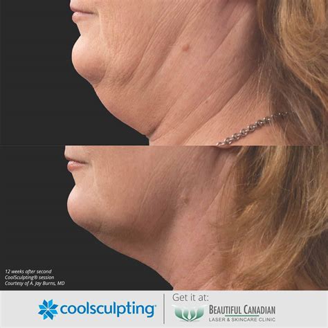 Double Chin Fat Removal