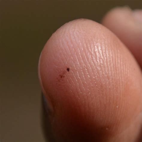 Melanoma on fingertip? : r/Melanoma