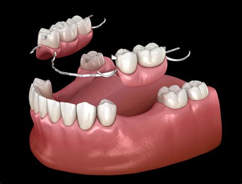 Partial Dentures / Implant Partial Dentures – Hasenfus Family Dental