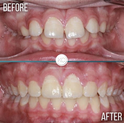 Braces Overbite Small Jaw at Jade Donovan blog