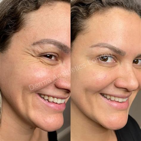 Crow's Feet | Derma Aesthetics London
