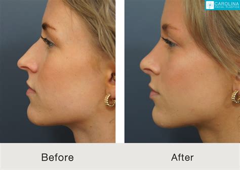 Deviated Septum Pictures Before And After