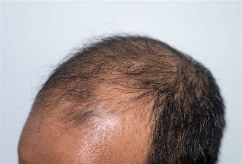 Men Hair Thinning, Causes and Treatment