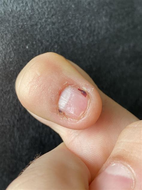 Splinter Hemorrhage – Splinter On Fingernail – DBLUK