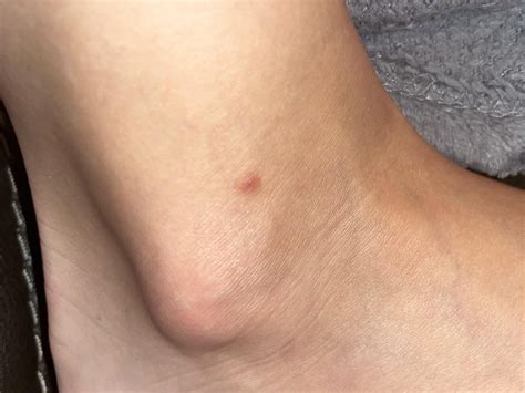 Unknown bumps on feet and ankles : r/AskDocs