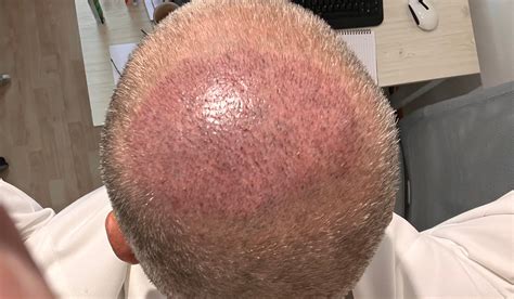 Reducing Hair Transplant Skin Redness After Surgery
