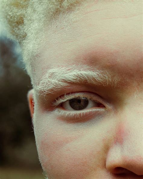 Close-up Portrait of Person with Albinism Outdoors · Free Stock Photo