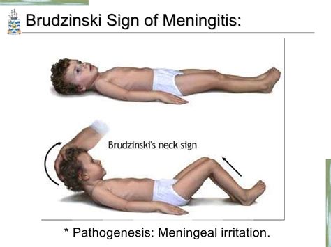 PPT - Pathology of Meningitis & CNS infections. PowerPoint Presentation ...