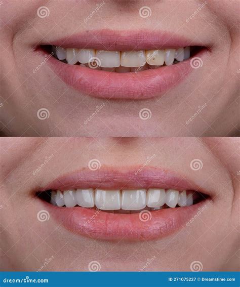 Before and after of Smile Makeover by Dental Ceramic Veneer, Porcelain Laminate Veneers on Front ...
