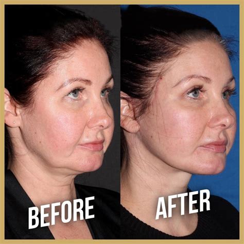 What Is Deep Plan Facelift Surgery? - Health & Beauty Travel