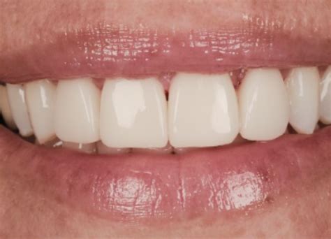 Gum Abscess Popped? Thinking of Popping It Yourself?