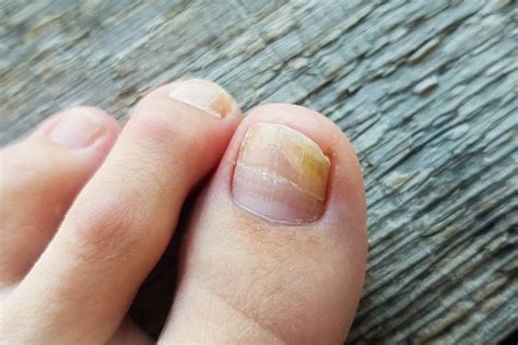 White Dry Spots On Toenails