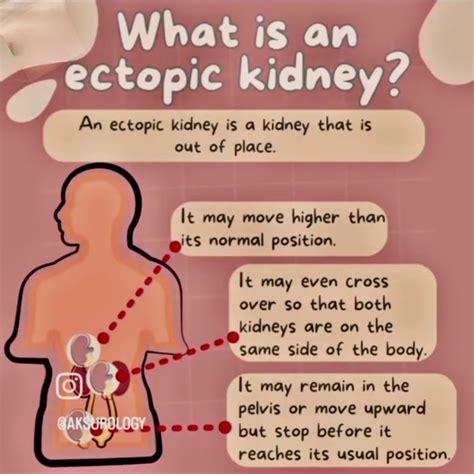 Anatomy Of Ectopic Kidney