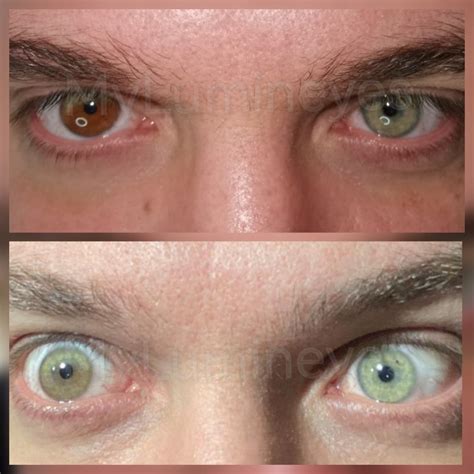 Can You Get Your Eye Color Change Surgery at Timothy Stump blog