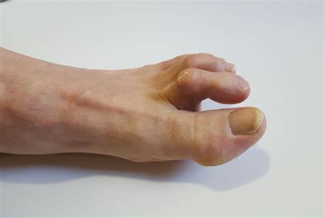 What Causes Hammertoe: Types, Diagnosis, Treatment