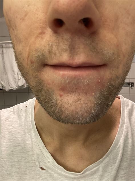 Zits Mouth Chin at Toni Esser blog